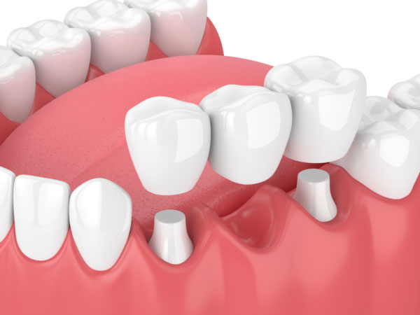 3d render dental bridges