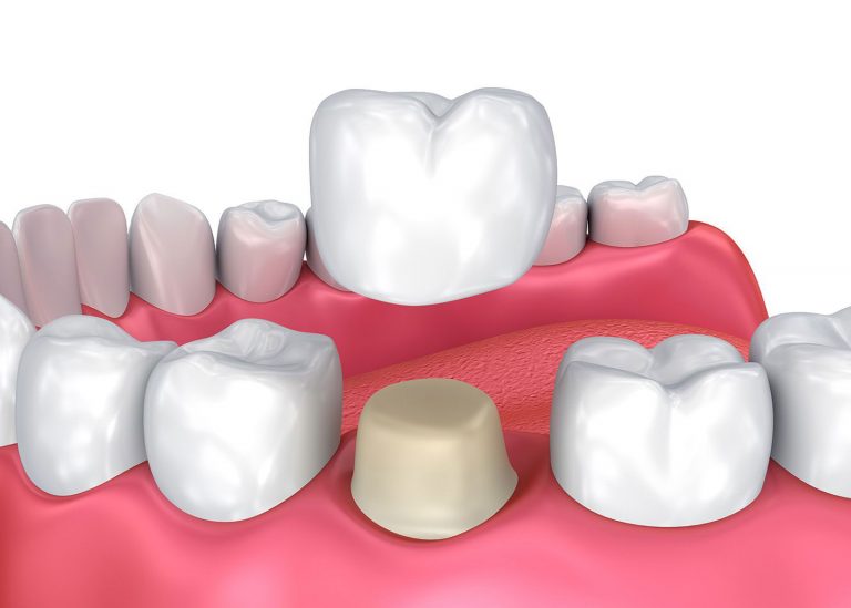 3d render dental crown