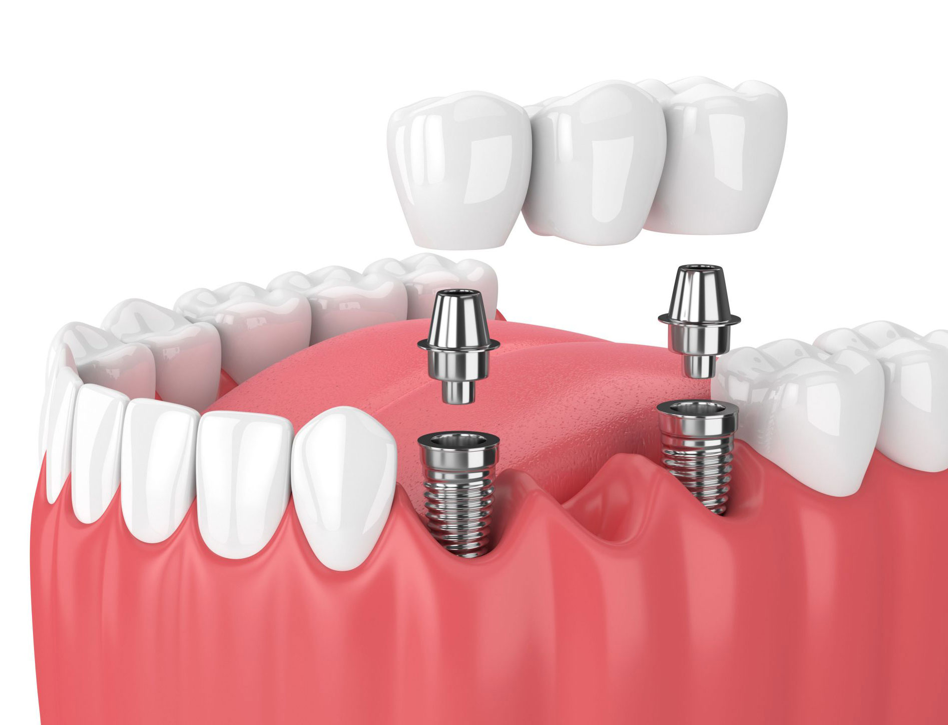 3d dental implant