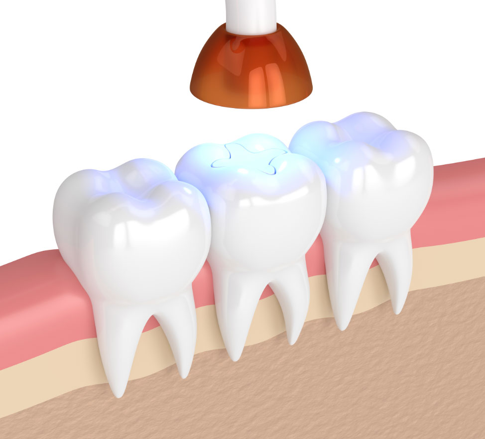 3d render resin filling cosmetic dentistry