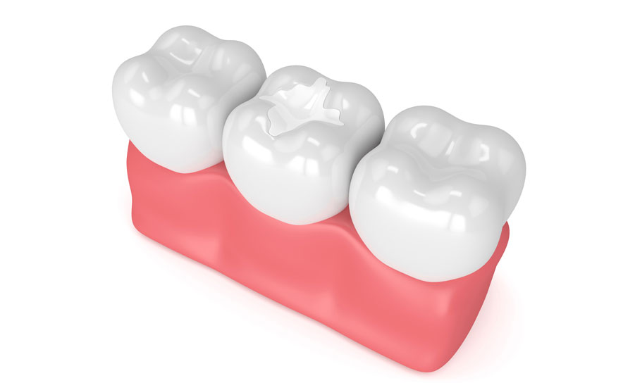 3d dental sealant
